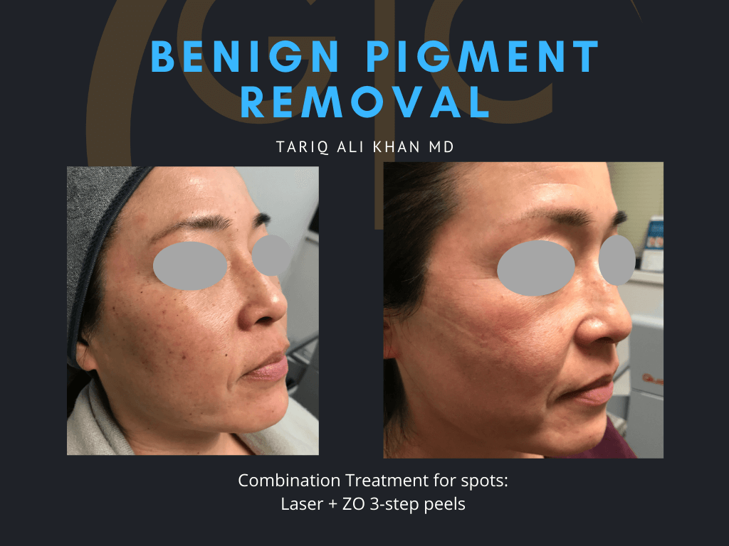 Gentle Care Laser Tustin & Long Beach Before and After picture - Mole Removal